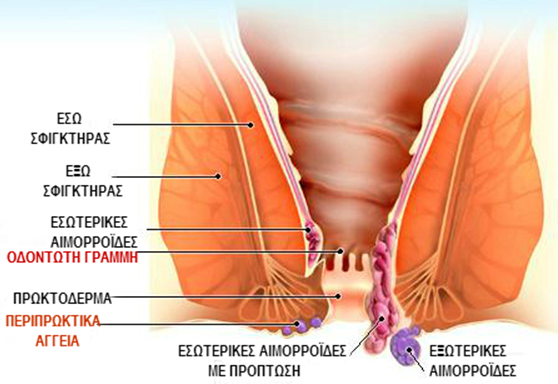 Τι είναι οι αιμορροΐδες;