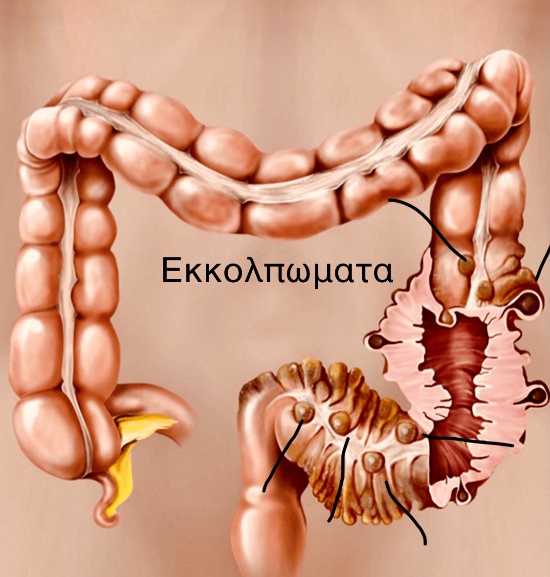 <strong>Εκκολπωμάτωση</strong>